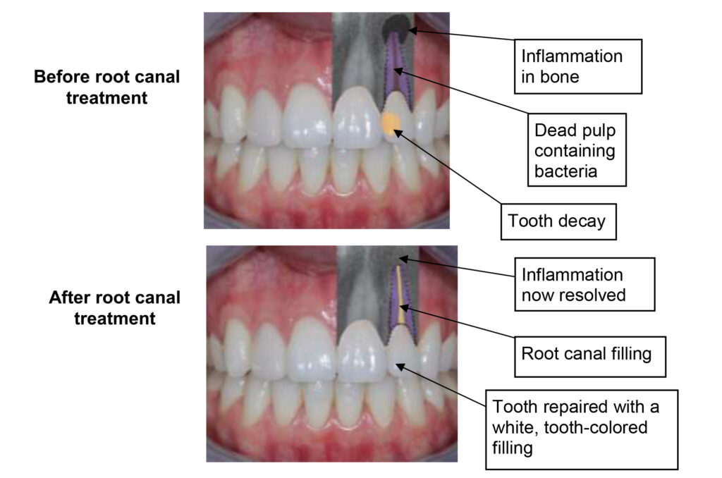 Root Canal